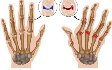 Rheumatoide Arthritis - Wie man die Symptome in den Griff bekommt