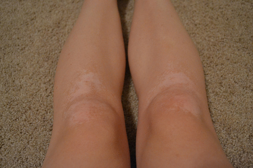 Vitiligo-beine