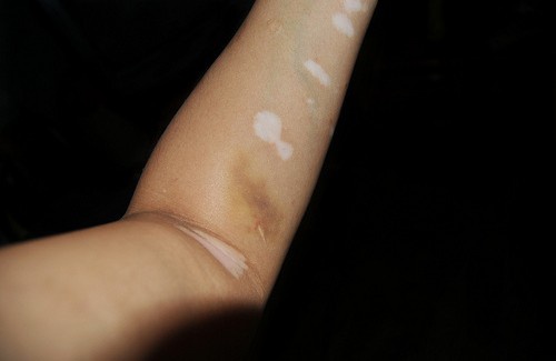 Hautpflege bei Vitiligo