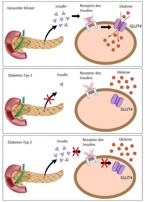Diabetes erkennen