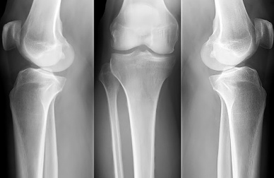 Hausmittel die zur Vorbeugung gegen Osteoporose hilfreich sein können