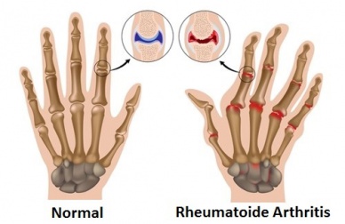 Arthritis natürlich lindern