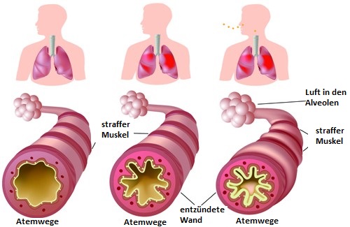 Chronisches Asthma und Allergien: Was kann ich tun?