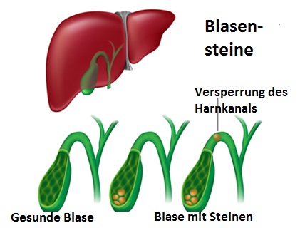 Blasensteine - Ursachen und Symptome