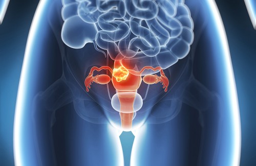 Schmerzhafte Endometriose: Hilfe aus der Natur