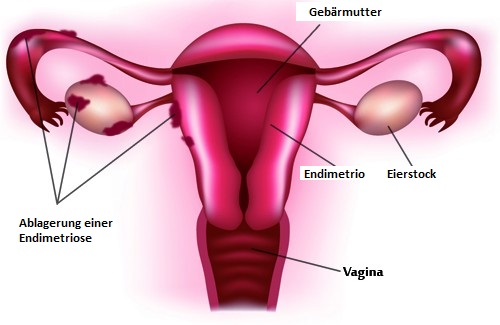 Endometriose – Hauptsymptome Endometriose – Hauptsymptome