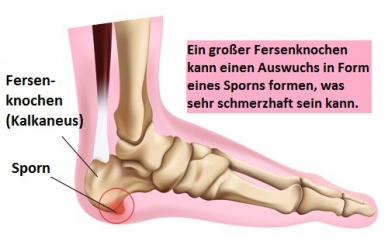 Fersensporn - Was kann ich tun?
