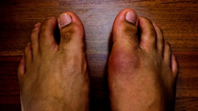 Schädliche Lebensmittel bei Gicht