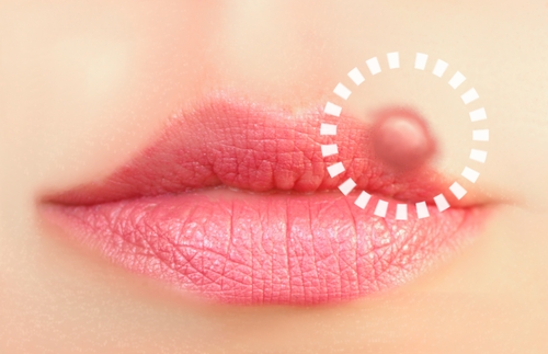 Lippenherpes – Natürliche Heilmittel