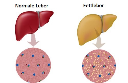 Fettleber Was Kann Ich Tun Besser Gesund Leben