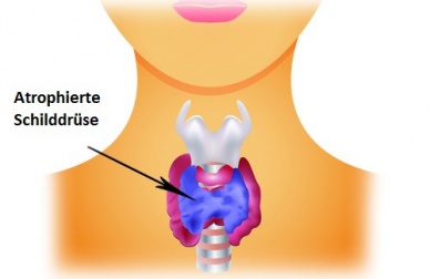 Hypothyreose: Wie können wir unsere Schilddrüse schonen?