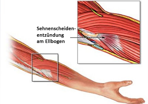 Sehnenscheidenentzündung-Ellenbogen