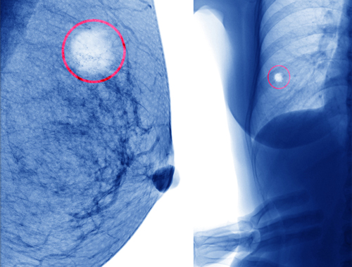 Brustzyste Radiographie