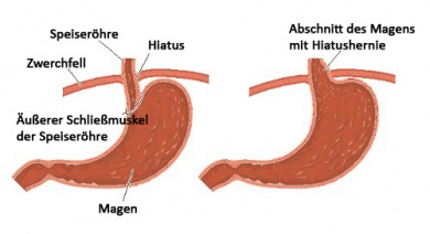 Zwerchfellbruch / Hiatushernie: was tun?