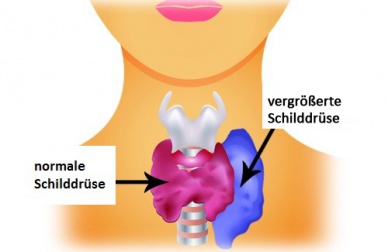 Hyperthyreose bei Frauen: Symptome und empfohlene Nahrungsmittel