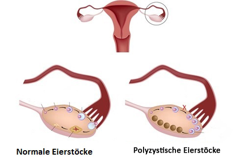 Polyzystisches Ovarialsyndrom - Was ist das?