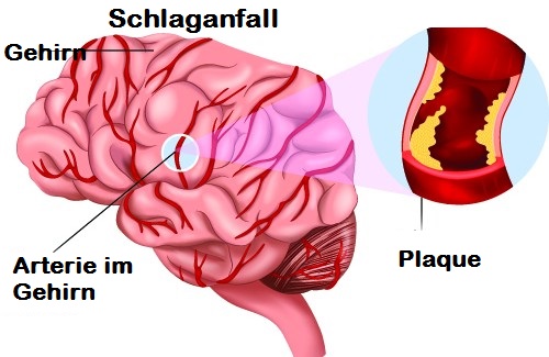 Schlaganfall: Richtig handeln, Leben retten! Schlaganfall: Richtig handeln, Leben retten!
