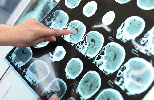 Alzheimer – Ist eine Vorsorge möglich? Alzheimer – Ist eine Vorsorge möglich?