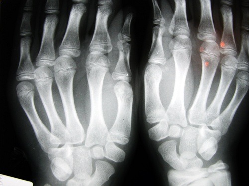 Arthritis