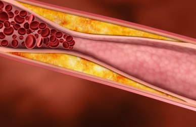 Gesunde Säfte gegen erhöhte Cholesterinwerte