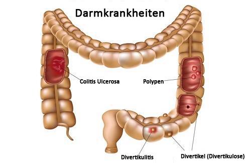 Dickdarmerkrankungen – Wie kann ich Vorsorge leisten? Dickdarmerkrankungen – Wie kann ich Vorsorge leisten?