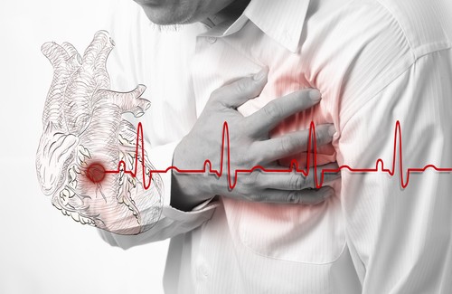 Herzinfarkt – Anzeichen und Symptome Herzinfarkt – Anzeichen und Symptome