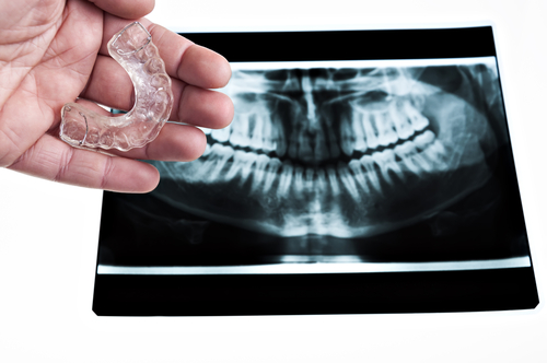 Die Knirscherschiene ist die beste Behandlungsmöglichkeit gegen Zähneknirschen.