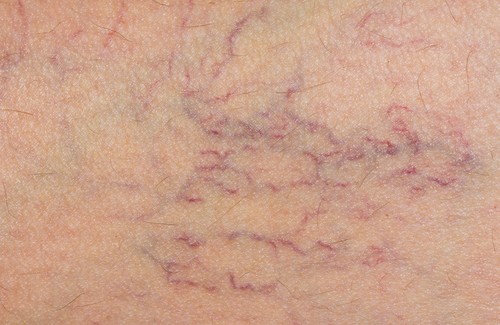 Rosskastanie – wirksam gegen Krampfadern Rosskastanie – wirksam gegen Krampfadern