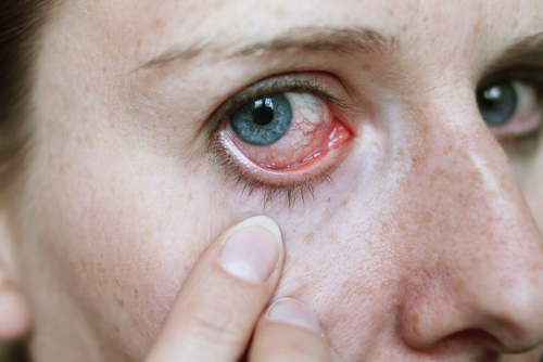Gerötete Augen