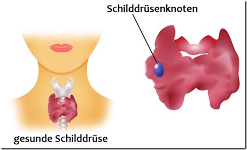 Schilddrüsenknoten – gutartig oder bösartig? Schilddrüsenknoten – gutartig oder bösartig?