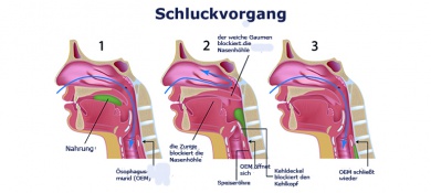 Heimlich-Handgriff >> Maßnahme bei Erstickungsgefahr