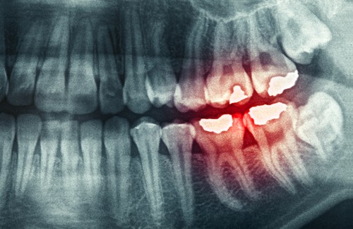 Zähneknirschen - Gründe und mögliche Folgen