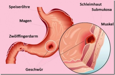 Natürliche Behandlungsmethoden für Magengeschwüre