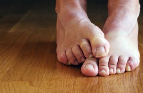 Nagelpilz natürliche Hausmittel