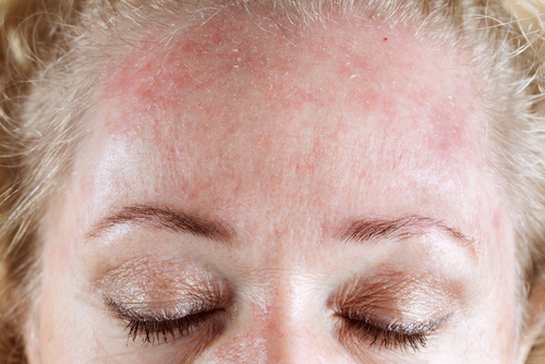 Allergie im Gesicht