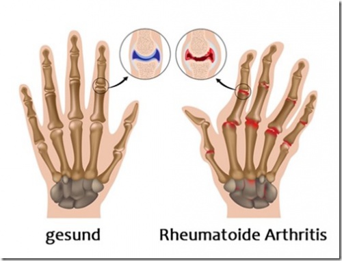 Arthritis-Hand