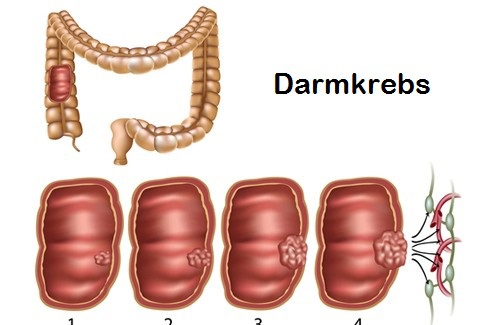 Wie kann man Darmkrebs erkennen und vorbeugen?