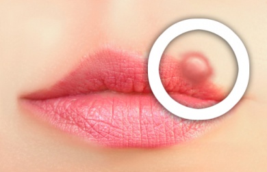 Vorsorge gegen Lippenherpes