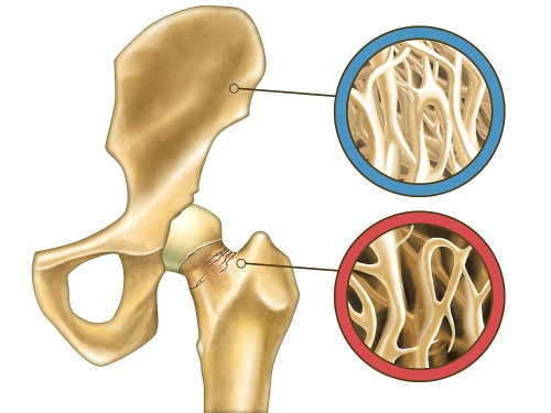 Osteoporosis