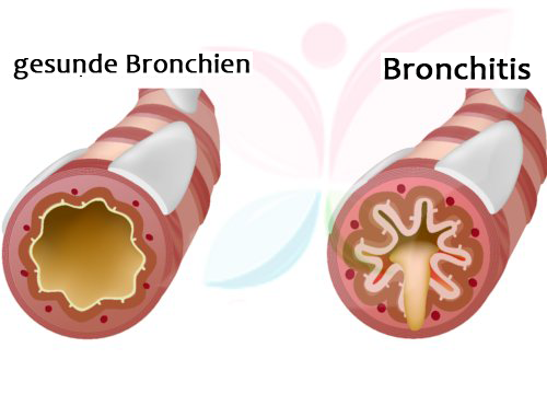 Brustschmerzen beim Husten durch Bronchitis