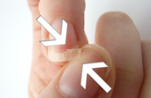 Brüchige Nägel: Gründe und Tipps Brüchige Nägel: Gründe und Tipps