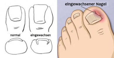 Eingewachsene Nägel - Was kann ich tun?