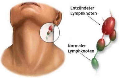 Entzündung der Lymphknoten