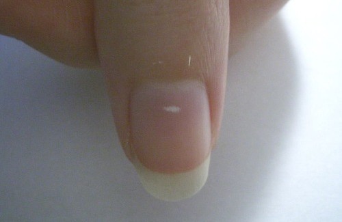 Was bedeuten weiße Flecken auf den Fingernägeln?