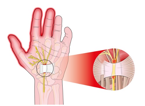 Karpaltunnelssyndrom als Ursache für Schmerzen in den Händen