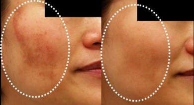 Melasma natürlich behandeln