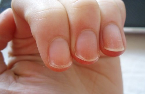 Was Fingernägel über die Gesundheit verraten