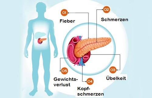 Erkrankungen der Bauchspeicheldrüse: 6 Symptome