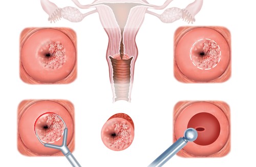Zervixerosion – Symptome und Behandlung