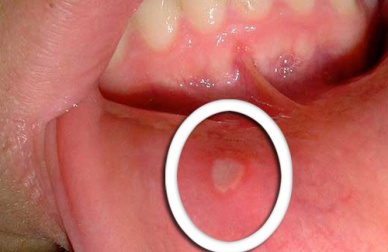 Aphthen: Was hilft gegen die kleinen Bläschen?